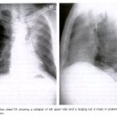 흉부 엑스레이 사진 (좌폐부분에 암세포) 이미지