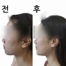 경북도청피부관리, 셀빅스 에어젯 청담에스테숲