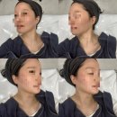 온다 - 서초구 신반포로 200 | 강남 온다리프팅 후기 및 날짜별 경과 (통증,가격,시술 효과)