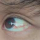 삼천당약국 | 프리다이빙 마스터 코스 Aida4 수강 중 마스크 압착으로 인한 각막하 출혈