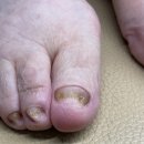 부산 발톱무좀 관리 후 확실한 변화를 느낀 엔피케어 연산점 방문기