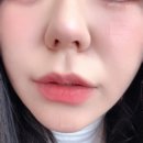 블랑쥬의원 | 대구 동성로 점제거,편평사마귀 제거 내돈내산 찐~후기 (전후사진o)