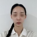 도쿄스킨케어 | 더숲에스테틱 | 이대웨딩케어 스킨부스터S 팔세미케어 솔직후기💆🏻‍♀️