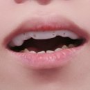 디메디 | 가족이 알려준 디메디코리아 마우스피스 사용후기 (내돈내산)