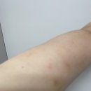 11500-19-26-17 | [팔/허벅지안쪽 람스 후기]3주차~4주차 멍, 통증, 바본, 후관리 추가 등(17~26일)