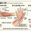 TNTs 지지 힐링 요령 이미지