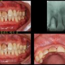 상악 전치부 임플란트 증례 이미지