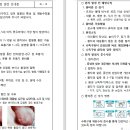 수족구및 구내염 안내 이미지