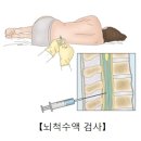 매독(Syphilis) 감염성 질환, 신장 비뇨기질환이란? 이미지