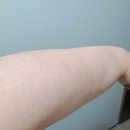 (주)시고디자인 | 압구정 로데오 팔뚝 지방분해주사 순삭주사 1회차 후기 (가격정보)