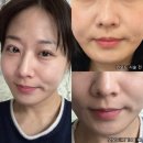 모즈의원 | 청담인모드 모즈의원 효과는? 통증, 붓기, 멍 인모드 내돈내산