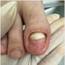 동탄무좀발톱 맞춤형 관리 무드비네일 닥터아이티엔 화성점 내성발톱 무좀 발각질
