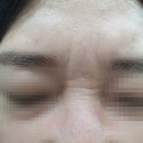 [내돈내산] 창원 성형외과 &#39;셀럽성형외과&#39;에서 미간&amp;콧등 보톡스 맞은 후기