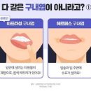 구내염 원인 빨리 낫는법 입안 헐었을때 이미지