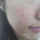청담 리무드 콜드플라즈마 솔직후기｜피지 제거부터 시술까지 상세 후기