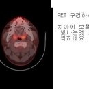 갑상선방사선 동위원소치료-화순전대병원 이미지