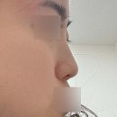 복코수술 긴코교정 더프라이드성형외과 자가늑코수술 전후후기