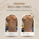 장산 체형관리 ‘레젤스킨앤바디’ 허리 골반 통증 개선 플러팅 테라피 찐후기