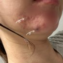 대정약국 | [여드름성 피부] 내돈내산 턱드름 피지낭종 속드름 제거수술 후기 (가격, 수술)