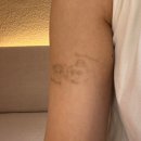 부산 서면 타투제거 : 14회차 후기 내돈내산