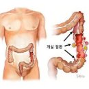 왼쪽 아랫배 누르면 통증 원인과 증상: 복부 땡김과 묵직함 찌릿함 이미지