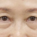 올리팅성형외과의원 | [강남역 올리팅 성형외과의원] 중년눈성형에서 사납지않은 쌍꺼풀을 위한 간단한 수술법, 눈썹하거상
