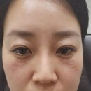유투성형외과의원 | 다크써클과 눈밑꺼짐에 1회시술로도 효과적인 림피드 후기-압구정유투성형외과