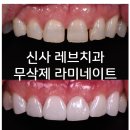 신사역 무삭제 라미네이트 : 레브네이트 내츄럴 최소삭제 비니어. 50대 앞니 벌어짐 비용/후기/얼굴사진.