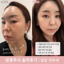팔자주름 볼패임 시술 땅콩주사 후기｜땅콩형 얼굴 개선