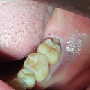 두려움을 제거하는 가장 빠른 방법 | [아산 사랑니 발치] 매복 사랑니 통증, 타이레놀만 먹어도 해결될까요?