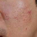 채한의원 | 여드름흉터한의원 미세침 관리 꾸준히 받았던 후기