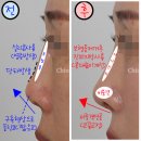 구축코재수술, 보형물만 바꾼다고 해결되지 않아요(자가진피지방 재건)