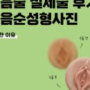 압구정-119 | 서울소음순수술전후사진 비교하는 법? 증상부터 디자인 개선까지