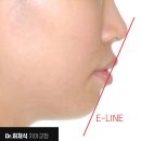 하나인치과병원 | 뻐드렁니교정 돌출앞니 치아교정 기간 비용 후기