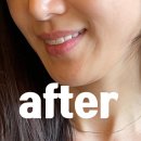 크라운 | 앞니 크라운 후기 | 주의사항, 체크할점,미용적 효과