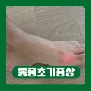 세움한의원 | 통풍초기증상이라니.. 발가락 통증 겪고 지금까지 먹고 있는 백년비술 안세린 후기