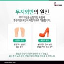 레푸스 경대점 이미지