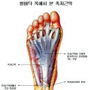 족저근막염의 원인,증상과 치료사례 및 치료원리 이미지