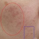 새살침 치료 4편 : 우측볼 여드름 흉터 7회 새살침 후기