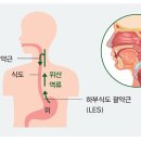 인후두 역류질환 원인과 예방법 이미지