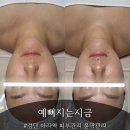 지금예뻐지는시간뷰티힐 | 검단 아라역피부관리 윤곽관리 예뻐지는지금 V-UP쉐이핑관리 솔직후기
