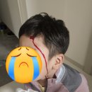 마더스약국 | 서울마더스 얼굴상처 전문센터 후기 / 5살이마찢어짐 / 이마봉합수술