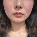 경주 리프팅 온다리프팅 2주 후 효과 후기