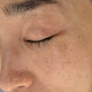 써니케어 | 써니뷰티 색소케어 2회차 후기 | 써니뷰티 재방문! 기미·잡티 관리 2회차 리얼 변화 공개