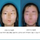 ........................................ | 윤곽수술 후기 참고사항