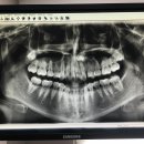 제 이빨 엑스레이를 공개합니다‼️‼️ 이미지