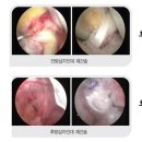 관절내시경,관절수술,무릎연골수술,반월상연골판파열,전방십자인대파열,관절수술,무릎수술,십자인대파열 이미지