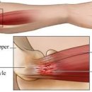 팔 저림과 손목 통증 증상 테니스 엘보 팔꿈치 외측 상과염 (Tennis elbow) 이미지