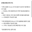 신장암 다발성폐전이 환자인데요 호흡기내과 교수가 와서 하시는말씀이 위치가 안좋아서 폐암가능성일수도 있다는데 이미지