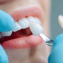 지디메디컬 | 라미네이트 vs 무삭제 라미네이트